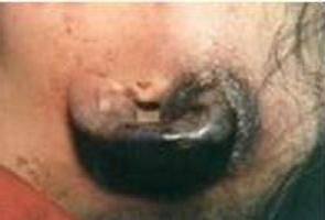 如何判断是否是血管性水肿