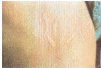 人工性荨麻疹的发病原因