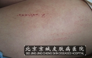 带状疱疹的护理