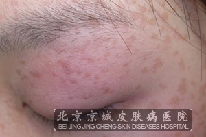 扁平疣的一般危害