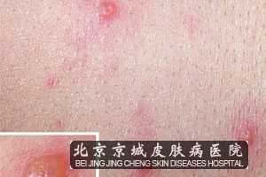 单纯疱疹是什么