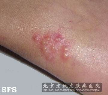 怎样诊断单纯疱疹