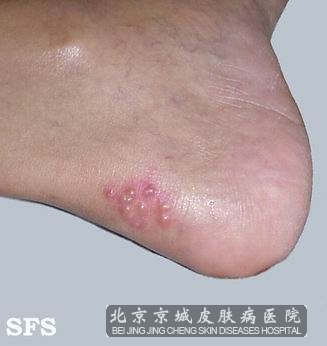 单传疱疹感染怎么办