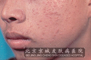 扁平疣患者要怎样正确的治疗