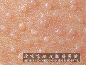 扁平疣患者要注意些什么