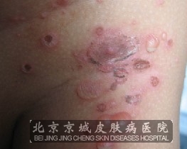 小儿脓疱疮该怎么治疗