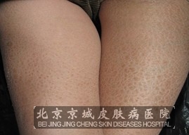 日常要如何治疗鱼鳞病