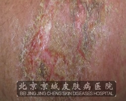 诊断深脓疱疮的方法有哪些