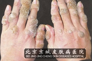 疣基的底部经常表现出炎症的反应特点,经过抓痒以后,症状的表现将会