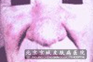 晚期酒渣鼻常用的诊治方法