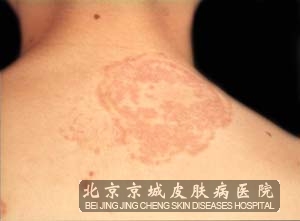 体股癣_体癣_股癣_体股癣怎么治疗_体股癣症状图片_(.