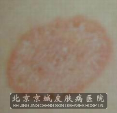 体癣是有季节性的_体股癣_北京京城皮肤病医院(北京