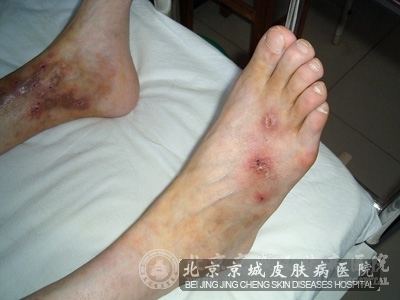结节性血管炎是什么_皮肤血管炎