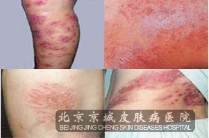 诊断鉴别荨麻疹应该注意什么