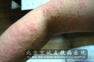 各种荨麻疹不同的治疗方法