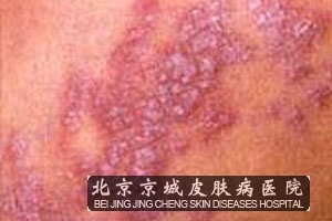 得了带状疱疹怎么办