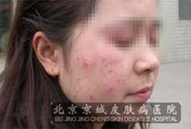 扁平疣该怎么治