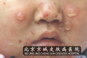 病毒性疱疹是怎回事