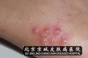 单纯性疱疹是由 单纯疱疹病毒所引起的一种急性疱疹性皮肤病,单纯性
