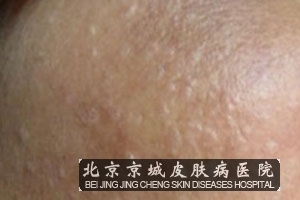 带状疱疹后遗症有什么