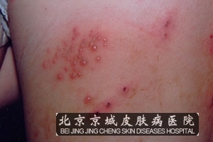 带状疱疹的一般治疗
