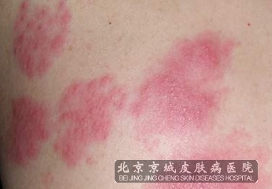 带状疱疹的预防和调理