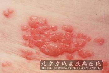 带状疱疹患者注意什么呢