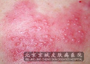如何判断是不是带状疱疹