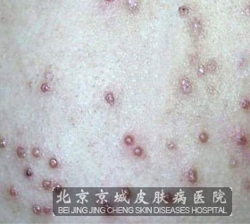 患上扁平疣应该注意些什么