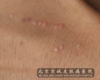 治疗扁平疣较佳方法是什么