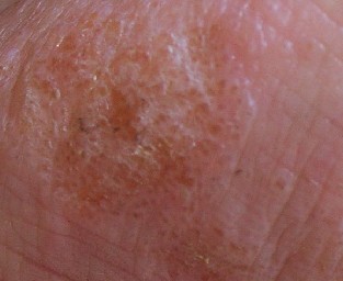 汗疱疹是一种比较常见的皮肤病,其损害主要位于手足
