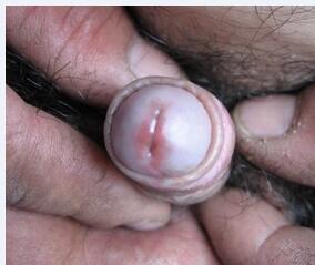 非淋菌性尿道炎患者图片