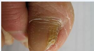 灰指甲治疗的方法有什么