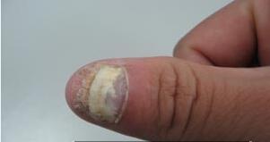 ��ָ�׳���֢״������ʲô