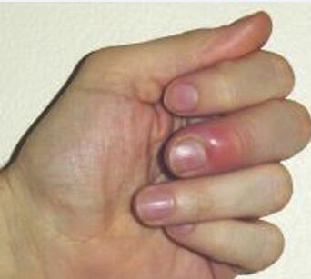 ��ָ�׵ĳ���֢״��ʲô��