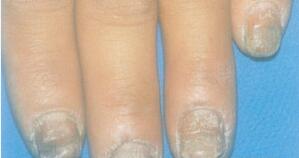 如何治疗灰指甲呢