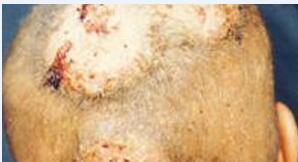 ��ͷѢ��֢״����ͷѢ��ô����