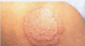 专家作答 股癣传染吗