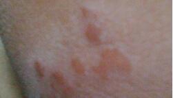 什么叫做紫外线过敏