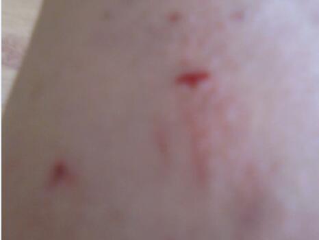 Ƥ�׻���Ӧע��ʲô