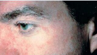 ֬����Ƥ�׵����Ҫ��