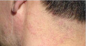 ֬����Ƥ�׵����ƺͻ�������