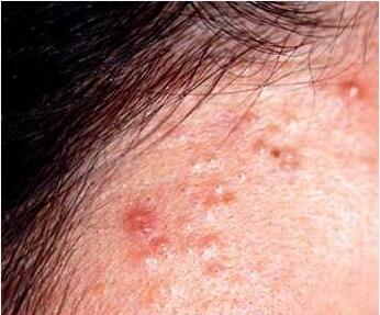 ֬����Ƥ�׵�֢״���ַ���