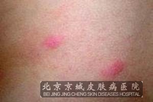 假期综合症中的丘疹性荨麻疹