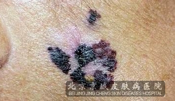 恶心黑色素瘤是一种非常可怕的皮肤病,它的死亡率也很高,所以患者们要