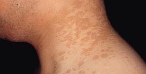 北京治疗花斑癣如何