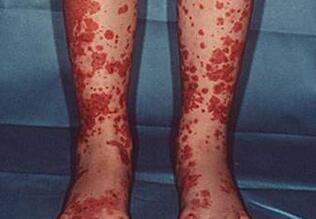 过敏性紫癜患者如何正确饮食