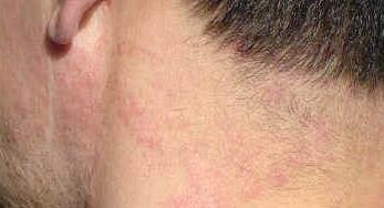 ֬����Ƥ�׵���Ϸ�������