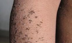 早期鱼鳞病的症状表现