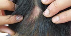 梅毒性脱发的症状有哪些